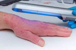 UV Light for Eczema